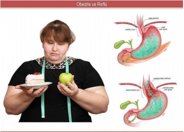 Obezite ve Reflü İlişkisi
