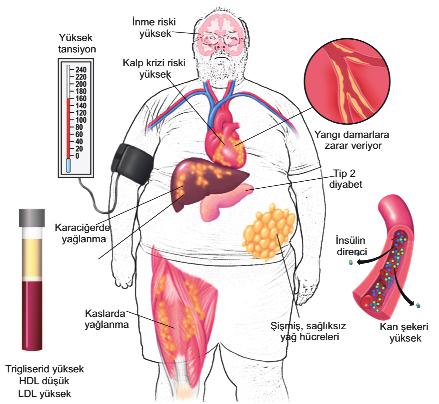 Obezite ve Metabolik Sendrom İlişkisi